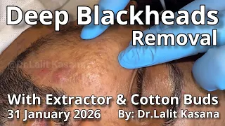 Deep Blackheads Removal Long Video by Dr.Lalit Kasana with Cotton buds & Extractor