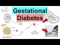 Gestational Diabetes Pregnancy Diabetes Causes Risk Factors Symptoms Consequences Treatment