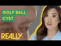 Dr Lee Removes 16-Year-Old GOLF BALL-Sized Cyst Dr Pimple Popper