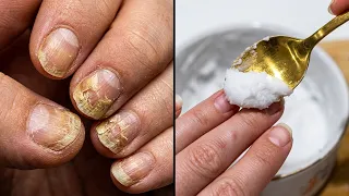 Ako imate žute i lomljive nokte – SAMO 2 SASTOJKA! Rezultat je šokirajući!