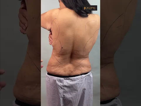 Upper Back, Lower Back Liposuction