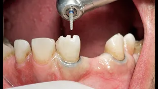 From Missing Teeth to a New Smile | Zirconia Crowns & Bridges 🦷🦷