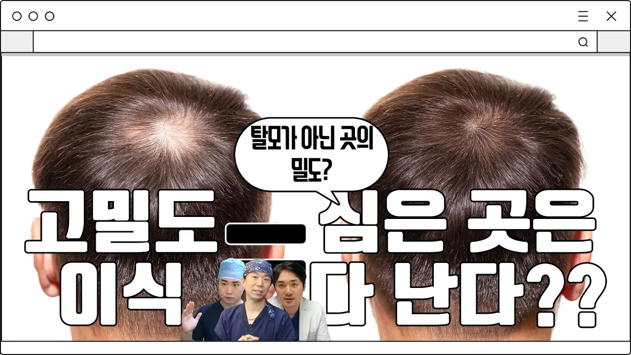 고밀도 이식은 탈모가 아닌 곳의 밀도? 심은 곳은 다 난다고 생각하면 될까요?│뉴헤어│모발이식