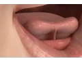 Download Lagu Tongue Tie Release Treatment