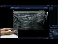 Ultrasound Evaluation of the Sural Nerve