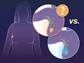 Omitting Sentinel-Node Biopsy in Small Breast Cancers NEJM