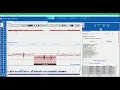 CytoSure Interpret Software - Setting up analysis protocols