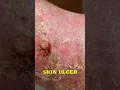 Brown Recluse Spider Venomous Bite