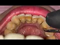 Download Lagu REMOVE TARTAR | SCALING | PEMBERSIHAN KARANG GIGI | Dentist | Dokter Gigi Tri Putra