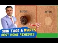 Skin Tags And Warts Will Disappear in 24 Hours - Dr Vivek Joshi