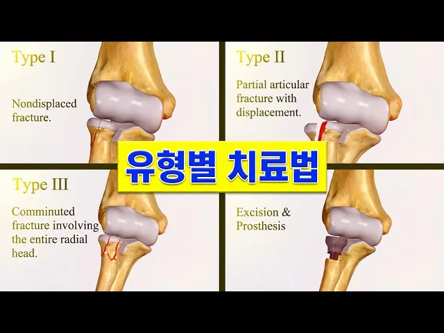 Radial Head Fractures: Types, Causes, and Treatment Options 요골두 골절: 유형, 원인 및 치료 방법