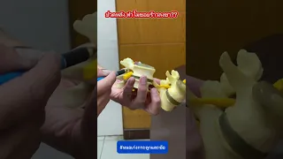  หมอนรองกระดูกเคลื่อนกดทับเส้นประสาททำให้เกิดอาการอะไรบ้าง 