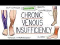 Understanding Chronic Venous Insufficiency