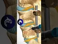 Download Lagu See how a Lumbar Fusion of the Spine works in 3D animation #backpain #stem #spine