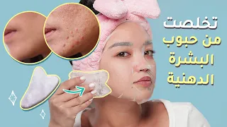 تعلمت من امي الروتين الصيني للتخلص من حب الشباب وتنظيف البشرة الدهنية مع كايسي 