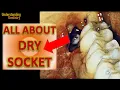 EASY Dry Socket after Tooth Extraction ALL TIPS to prevent and Treat