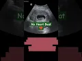 Vaginal bleeding at 6 weeks Ultrasound reveals