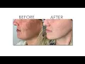 iBeauty MedSpa Toldedo Ohio Lumecca Treatments