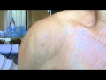 Muscle Twitching and Spasms NEJM