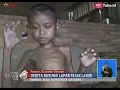 Download Lagu Remaja 15 Tahun Penderita Busung Lapar dan Katarak, Tidak Pernah Dapat Bantuan  - BIS 31/01