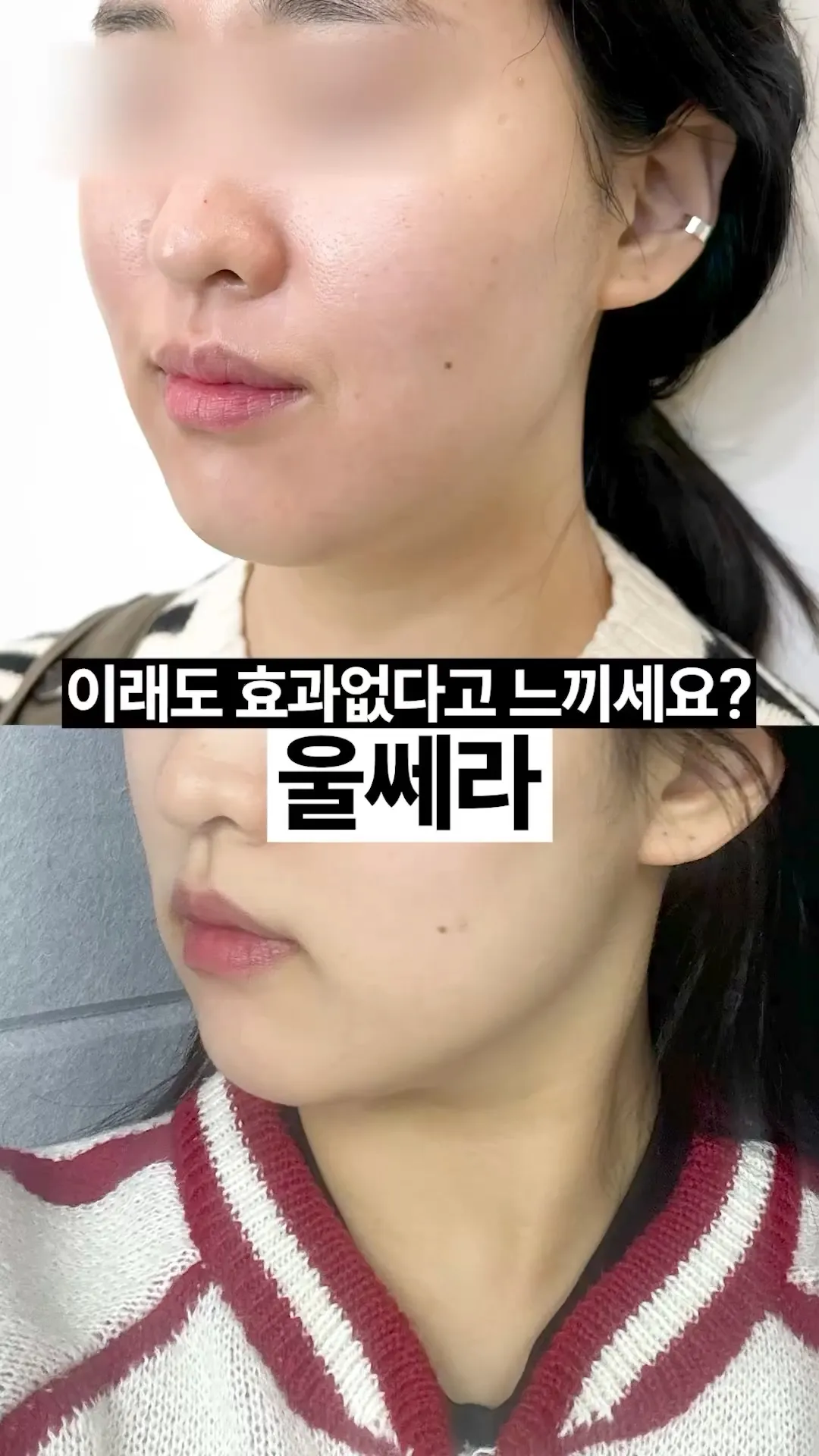 흐릿한 턱선 울쎄라로 바로 잡기✅