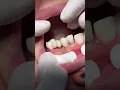 Download Lagu Fixed bridge #dentist #dental