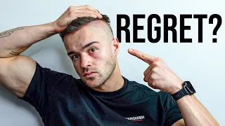 Did I Get The Hair Transplant Too Young?
