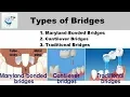 Types Of Dental Bridges