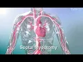 Septal Myectomy: Surgical Procedure for Hypertrophic Cardiomyopathy (HCM) | Tufts Medicine