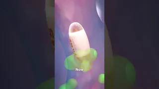 Pill Camera Explained What If It Gets Stuck