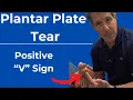 Cause of V Toes Plantar Plate Tear