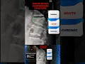 Spinal Compression Fracture on X-ray
