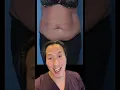 Great Tummy Tuck Results by Dr Youn
