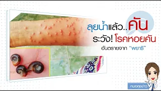  จะป้องกันการติดพยาธิหอยคันได้อย่างไรเมื่อต้องสัมผัสแหล่งน้ำ 