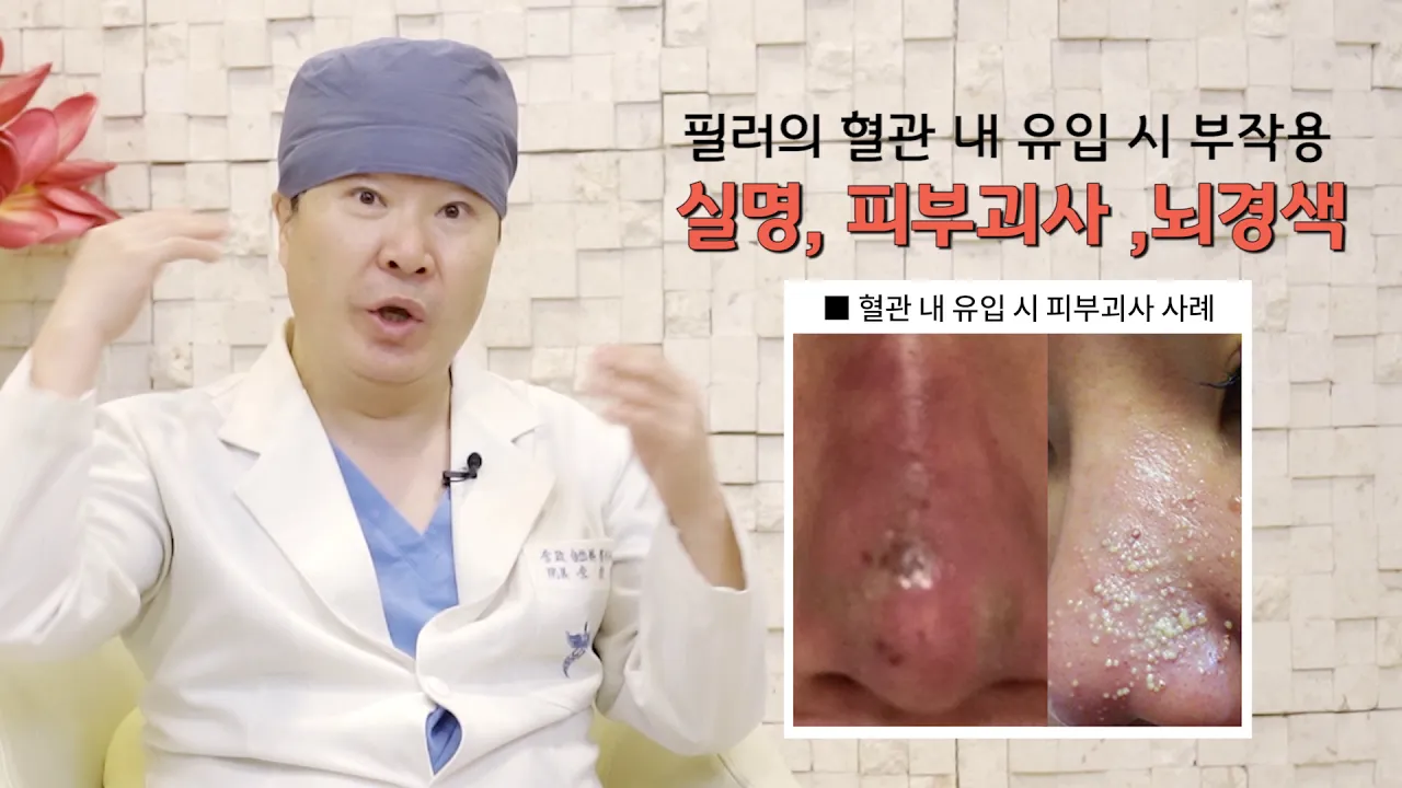아테콜필러의 질감 #자가조직과 유사 #반영구 필러 #제거가능 #30년 사용