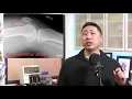 How to Identify Knee Effusions on a Lateral Knee X-Ray