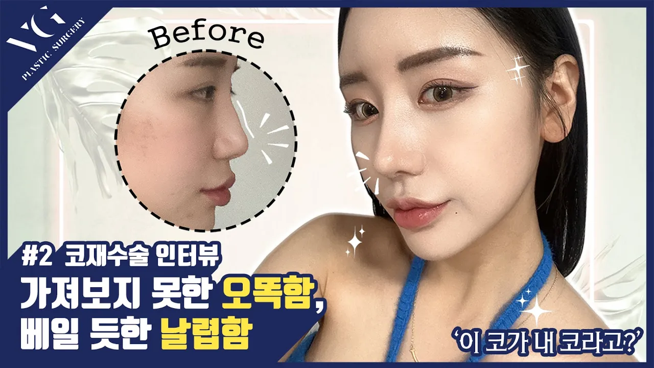 #코재수술  #성형 #브이로그 두번은 없는 코재수술인터뷰😎가져보지 못한 오똑함, 베일 듯한 날렵함!
