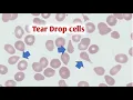 Download Lagu Tear drop cells II tear drop cells causes