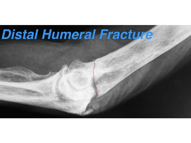 distal humeral fractures