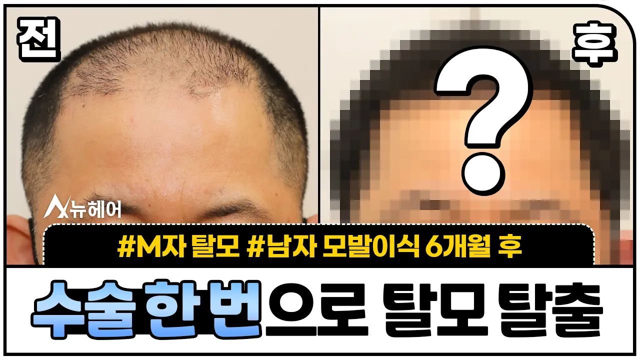 모발이식으로 딱 한 번 수술하고 탈모 탈출하는 법ㅣ1500 ~ 2000모낭ㅣ뉴헤어