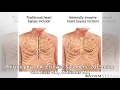 Aortic valve surgery - minimally invasive MedlinePlus Medical Encyclopedia