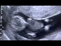 Lagu Sonogram:  Singleton Pregnancy at 11 weeks