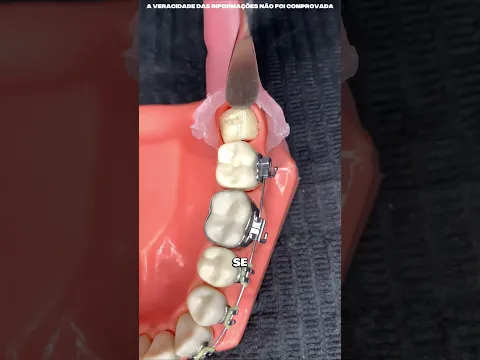 A verdade sobre o dente incluso! 🦷  #frozen #museudearte #viral #curiosidades