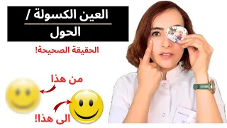 العين الكسولة الحول ماذا بالضبط يعني هذا كيفية التعامل معها 