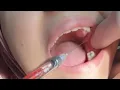 Inferior Alveolar Nerve block
