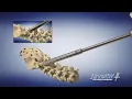 Download Lagu CTL Amedica: Javelin MIS Locking Facet System