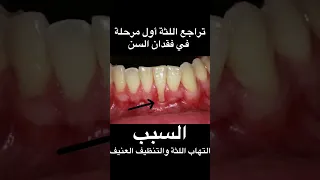 حذاري من تراجع اللثة لا تهمله قد تفقد أحد أسنانكshorts 