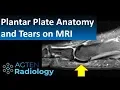 How to Assess Plantar Plate Anatomy and Tears on MRI