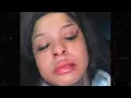 Chrisean Explains how she lost her tooth