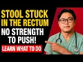 Stool STUCK in the Rectum What is it and what to do Doctor Explains